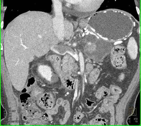 Incidental Adrenal Cyst In Patient With Invasive Pancreatic Cancer