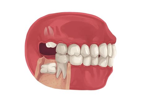 How To Manage A Broken Wisdom Tooth Authority Dental