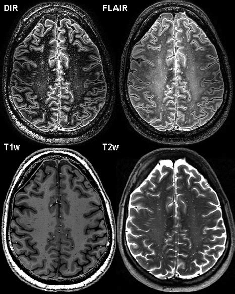 3d Ax T1 Mri