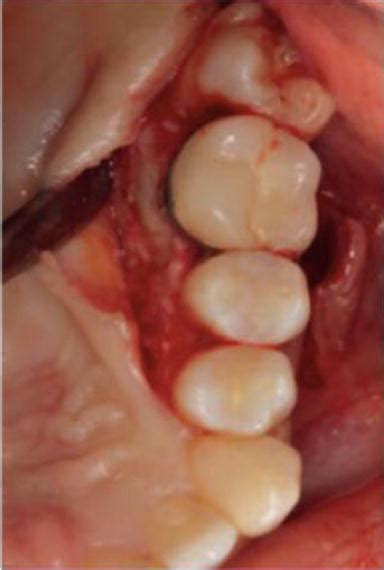 Flap Techniques In Dentoalveolar Surgery Intechopen