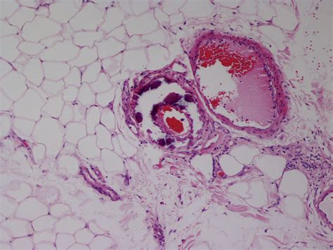 Warfarin Induced Skin Necrosis Progressing To Calciphylaxis Journal Of Plastic Reconstructive