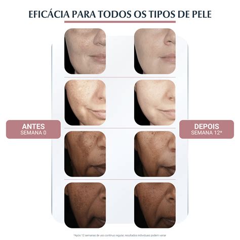 Eucerin Pigment Antes E Depois - Anti-Pigment Dual Sérum | Hiperpigmentação | Eucerin Brasil