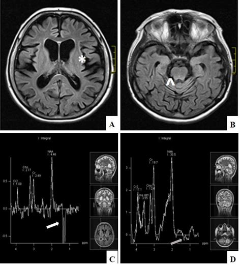 Diffuse Cerebral A And Cerebellar Atrophy B On Mri Flair