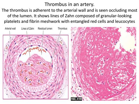 Hemodynamic Disorders Thromboembolic Disease Shock Hypercoagulable