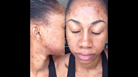 How To Get Rid Of Acne And Hyperpigmentation Review Youtube