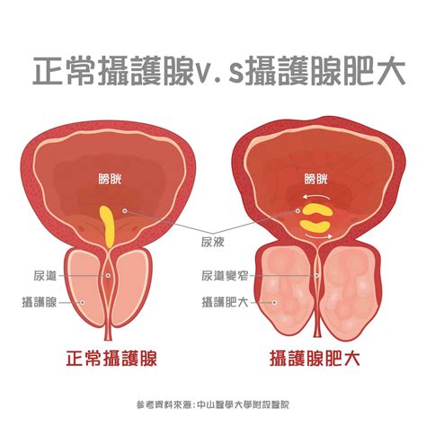 攝護腺肥大5原因！前兆7症狀要注意！治療2大方法一次看 Hello健康