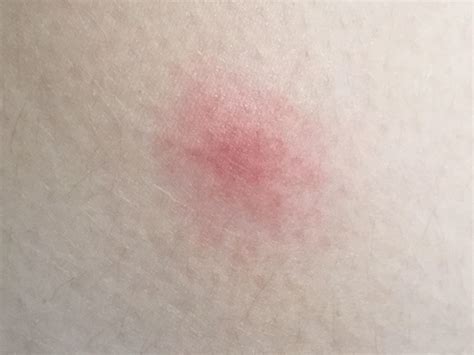 Flag of Japan but it’s a mosquito bite : r/vexillologycirclejerk