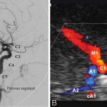 Normal Anatomy Of The Carotid Siphon Lateral View DSA A And Anterior