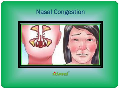 Icd 10 Nasal Congestion 8