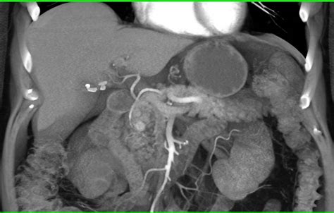 Incidental Cm Neuroendocrine Tumor In The Head Of The Pancreas