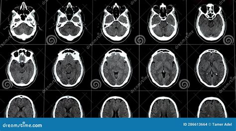 Brain Ct Scan Showing Brainstem Cavernoma Right Centrum Semiovale