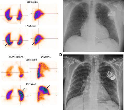 Ventilation Perfusion Single Photon Emission Computed Tomography V P