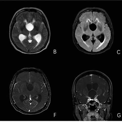 MRI of the patient's brain and pathological results. (A-E) MRI of the ...