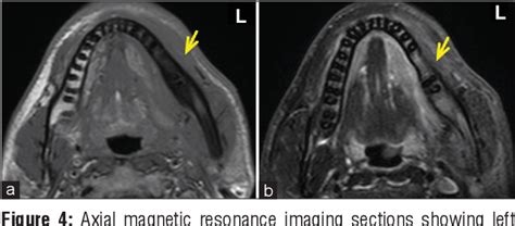 Figure 1 From Chronic Diffuse Sclerosing Osteomyelitis Of The Mandible Semantic Scholar