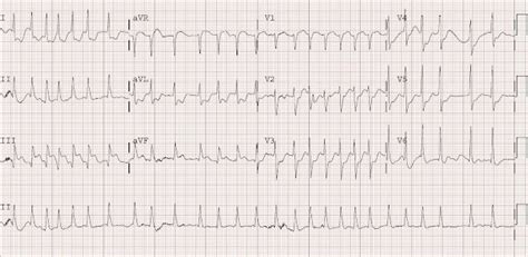 Dr. Smith's ECG Blog: Atrial Fibrillation with RVR and Inferoposterior ...