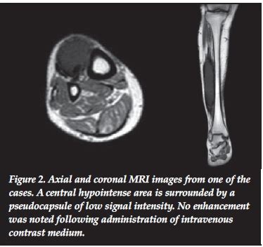 Calcific Myonecrosis Following Snakebite