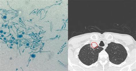 Caz Unic N Lume Un B Rbat A Fost Diagnosticat Cu Chondrostereum