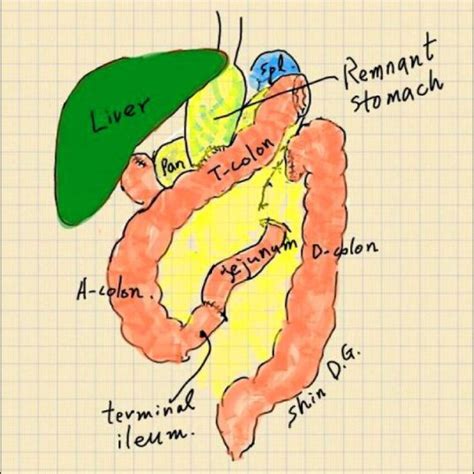 Resected Strangulated Small Bowel Specimen Image All The Small Bowel