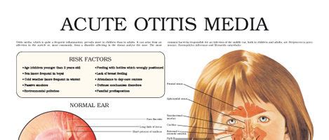 Acute otitis media – Anejo