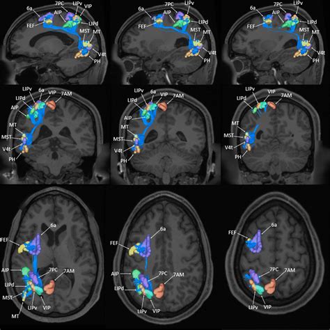 Tractographic Model Of The Dorsal Attention Network Dan As Shown On