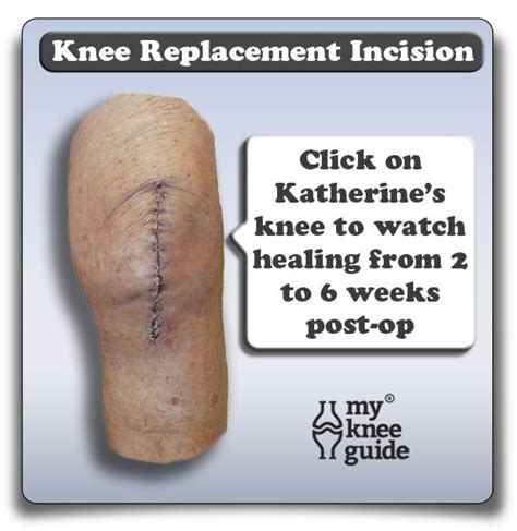 50 best images about Knee Replacement on Pinterest | Knee pain, Health ...