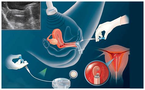 Intrauterine Insemination Iui Fertility Treatment In Jalgaon