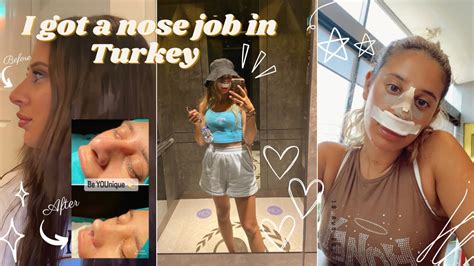 I GOT A RHINOPLASTY NOSE JOB IN TURKEY Dr Yusuf Orhan Uçal Clinic