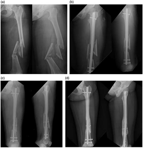 A 23 Year Old Woman Case No 8 Sustained A Left Complex Femoral Shaft