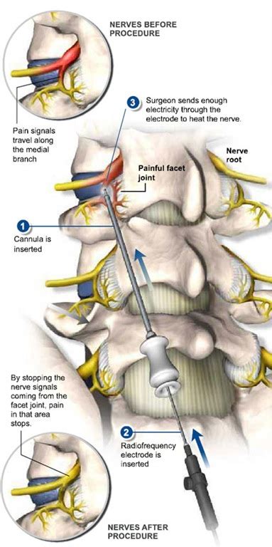 Radiofrequency Ablation of the Medial Branch Nerves - Best Pain Doctor NYC