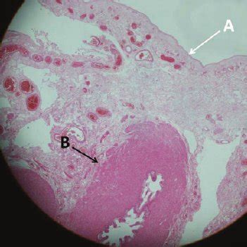 Sliding indirect inguinal hernia sac. ( A ) The hernia sac. ( B ) Testis | Download Scientific ...