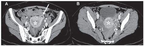 Radiologia Brasileira Gravidez Ect Pica Ensaio Iconogr Fico