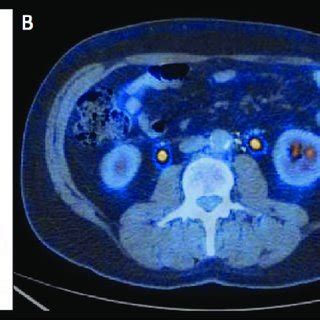 A Mip B Transaxial And C Sagittal F Fdg Pet Ct Fused Image