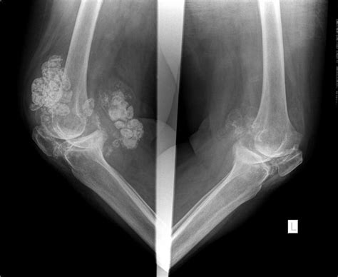 Osteochondromatosis Radiology Synovial Chondromatosis Wheeless