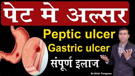 पेट में अल्सर सम्पूर्ण इलाज I Peptic Ulcer Gastric Ulcer Esophageal Ulcer In Hindi Youtube