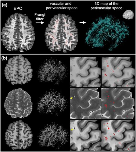 Mapping Perivascular Space Pvs A An Example Of Pvs Segmentation