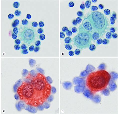 Mesothelioma Vs Reactive Mesothelial Cells Cytology 2022E Jurnal