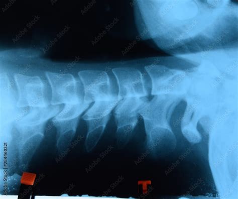 X-ray of the cervical vertebrae. X ray image of the cervical spine ...