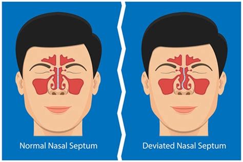 Herbal Remedies for DNS (Deviated Nasal Septum)