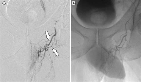 Rectal Artery Embolization For Hemorrhoidal Disease Anatomy