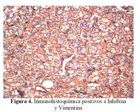 Tumor De C Lulas Esteroideas De Ovario Reporte De Un Caso Y Revisi N