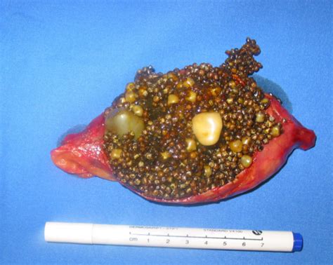 Real Gallbladder