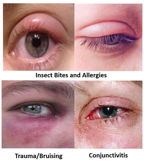 How To Reduce Swollen Eyes From Insect Bites