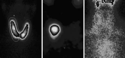 Thyroid Scintigraphy With Na 99m Tc Tco 4 A Graves Disease B