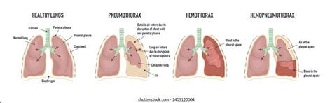 Illustration Of Pneumothorax Hemothorax And Hemopneumothorax Stock