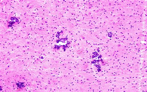 Pathology Outlines Gangliocytoma Ganglioglioma