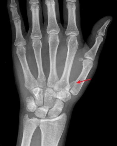 Bennett fracture causes, symptoms, diagnosis, treatment & prognosis