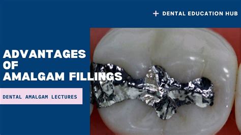 What Are Advantages Of Amalgam Fillings Youtube