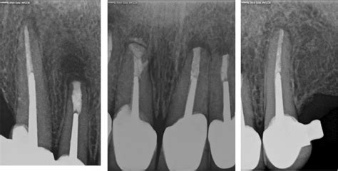 Periapical radiograph showed healing of periapical lesion of the of... | Download Scientific Diagram