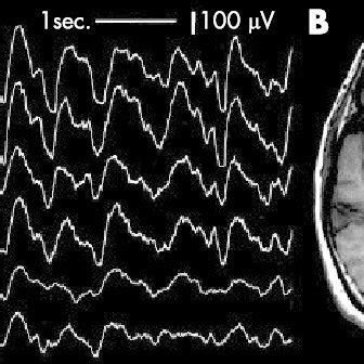 EEG showing triphasic waves (A). T1 axial scan (B) showing signal ...