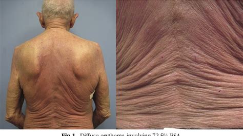 Figure From Pembrolizumab Associated Tumor Development In A Patient